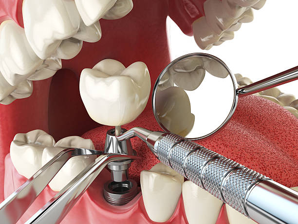 Best Emergency Tooth Extraction in Bristol, FL